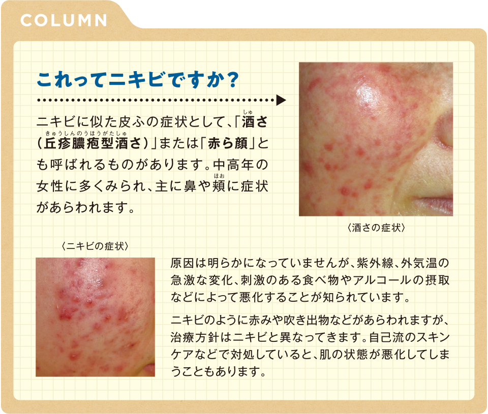 これってニキビですか?